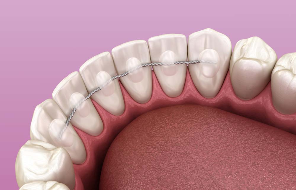 Digital image of lingual wire retainer installed after orthodontic braces treatment adult lingual wire braces on back of teeth
