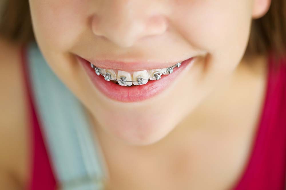 Young girl smiling with ceramic bracket braces young girl with orthodontic treatment braces