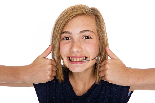 A,Cute,Young,Girl,Wearing,Orthodontic,Headgear headgear retainer orthodontic treatment